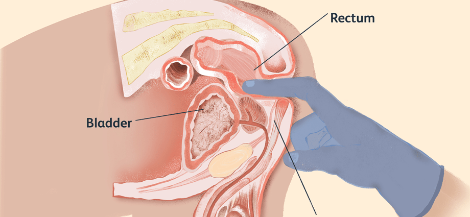 Be a man and have a prostate examined, or how to get a guy to undergo a prostate test?