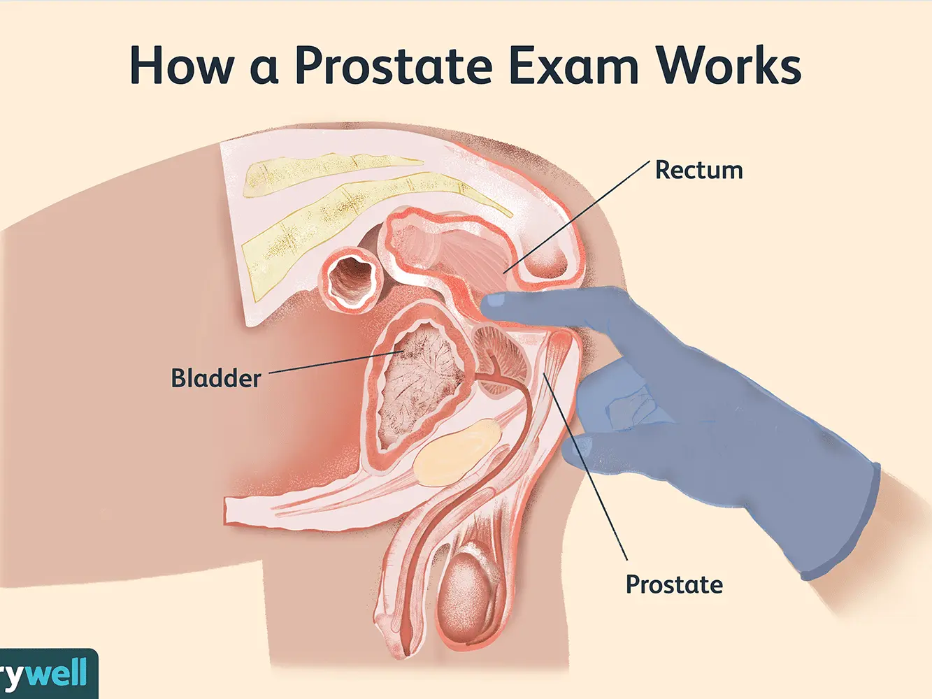 Be a man and have a prostate examined, or how to get a guy to undergo a prostate test?