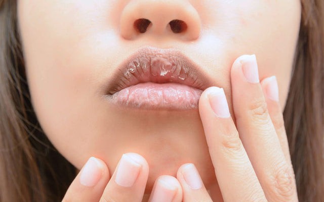 Beautiful lips &#8211; what to do so that they are not dry? Ways to dry lips