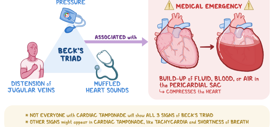 Beck&#8217;s triad &#8211; what is it? Beck&#8217;s triad symptoms and causes [EXPLAINED]