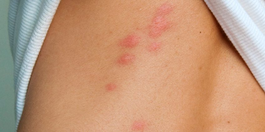 Bedbug bite &#8211; the appearance of the parasite, symptoms, diseases