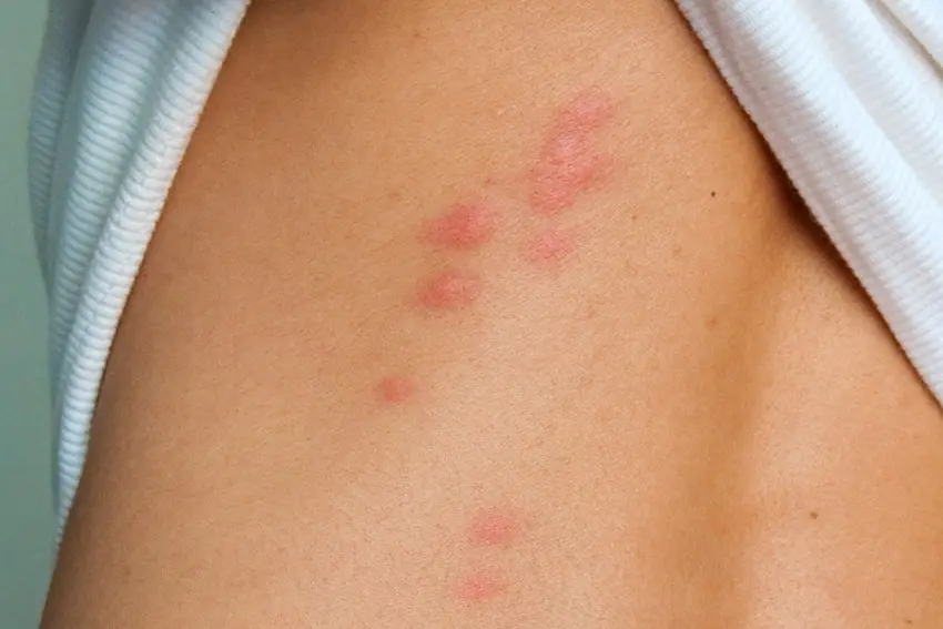 Bedbug bite &#8211; the appearance of the parasite, symptoms, diseases