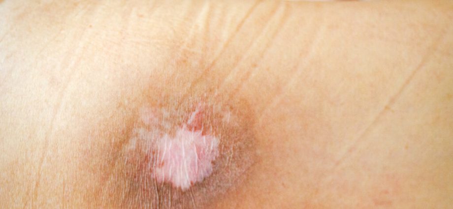 Bedsores, chafing and abrasions. How do they arise and how to treat them?