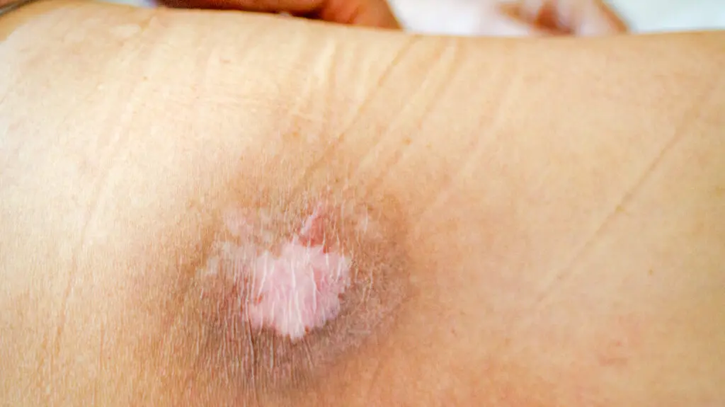 Bedsores, chafing and abrasions. How do they arise and how to treat them?