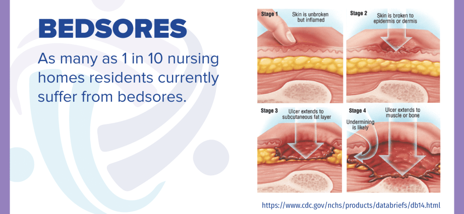 Bedsores &#8211; when are they at risk, how to treat and prevent them?