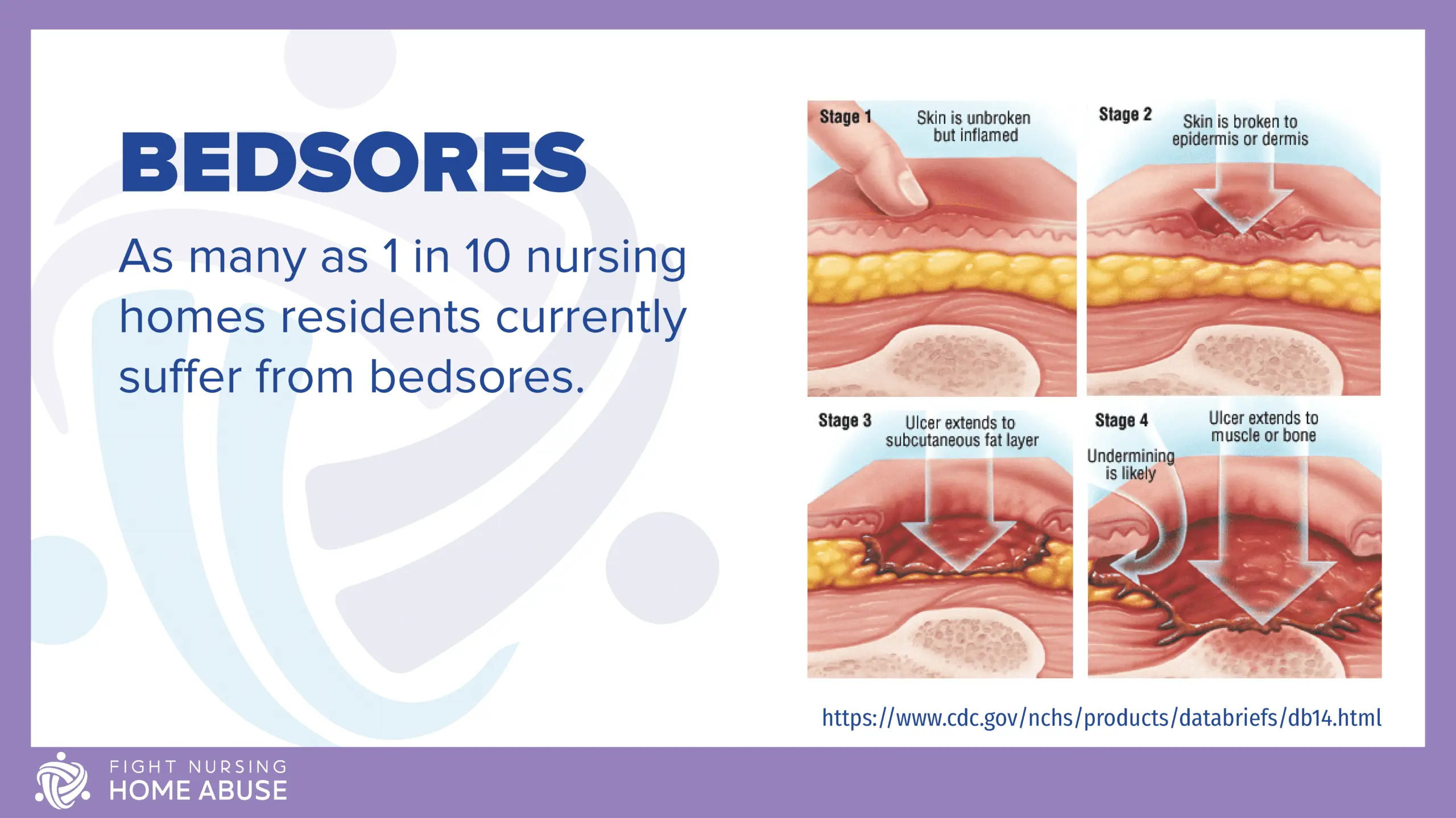 Bedsores &#8211; when are they at risk, how to treat and prevent them?