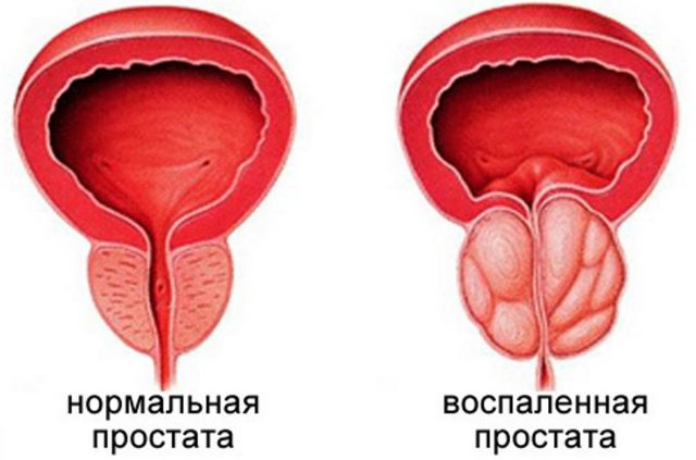 Bee death: treatment of prostate adenoma