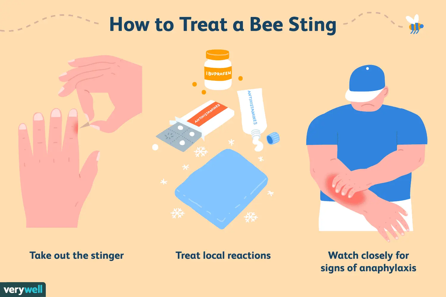 Bee sting &#8211; symptoms and first aid in case of stings