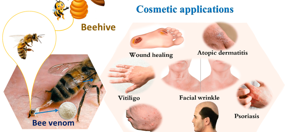 Bee venom &#8211; allergy, drug, diagnosis, allergy