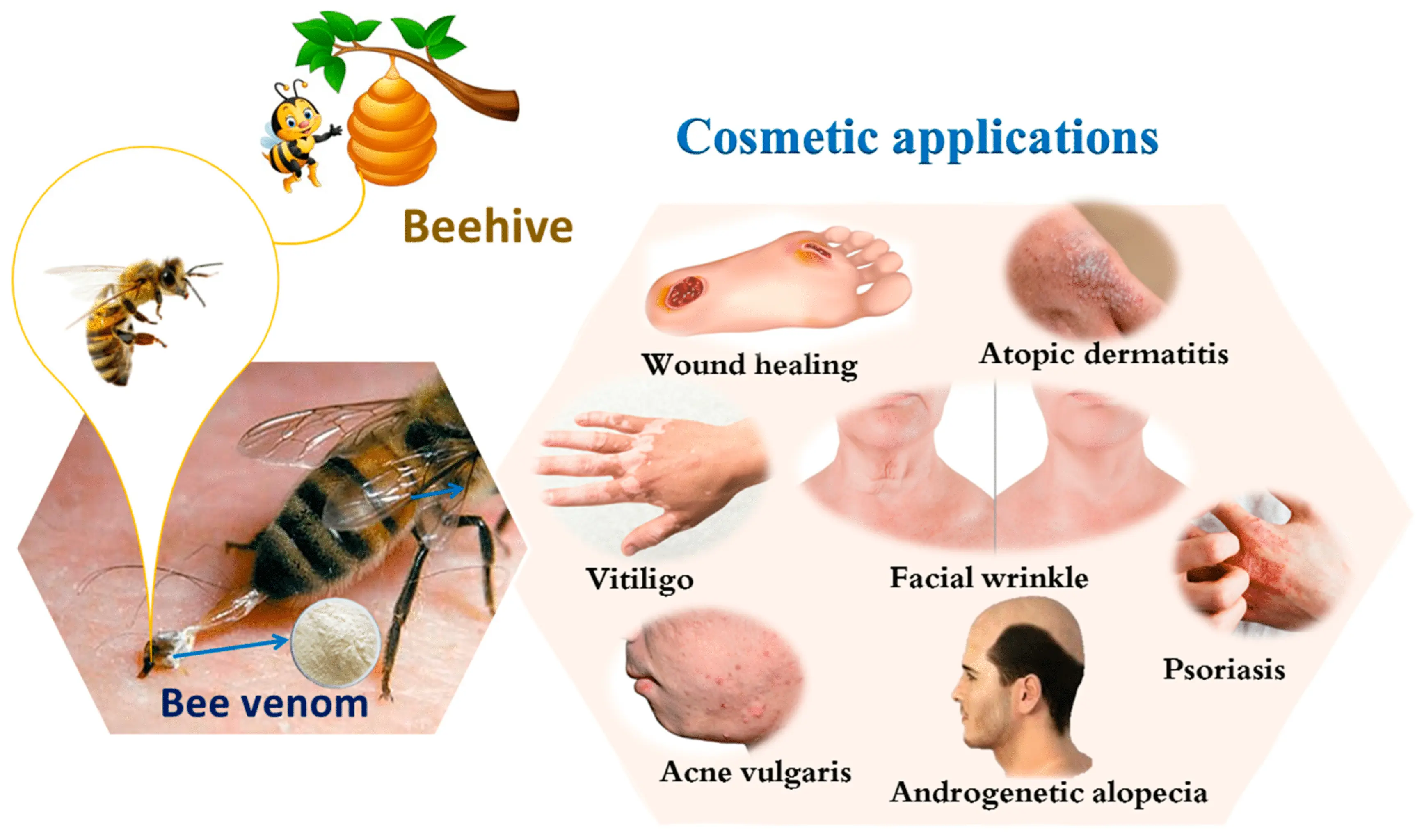 Bee venom &#8211; allergy, drug, diagnosis, allergy