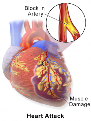 Being in constant noise increases your risk of heart attack and stroke