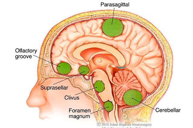 Benign brain tumors &#8211; what to look for, surgery