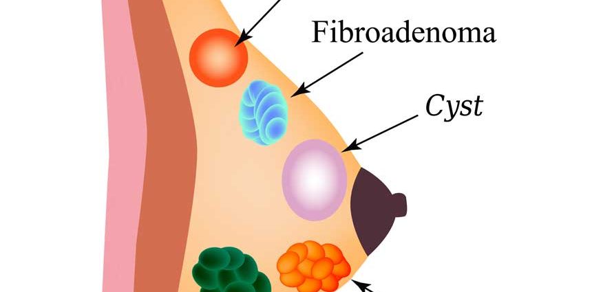 Benign breast diseases. How to treat papillomas and cysts?