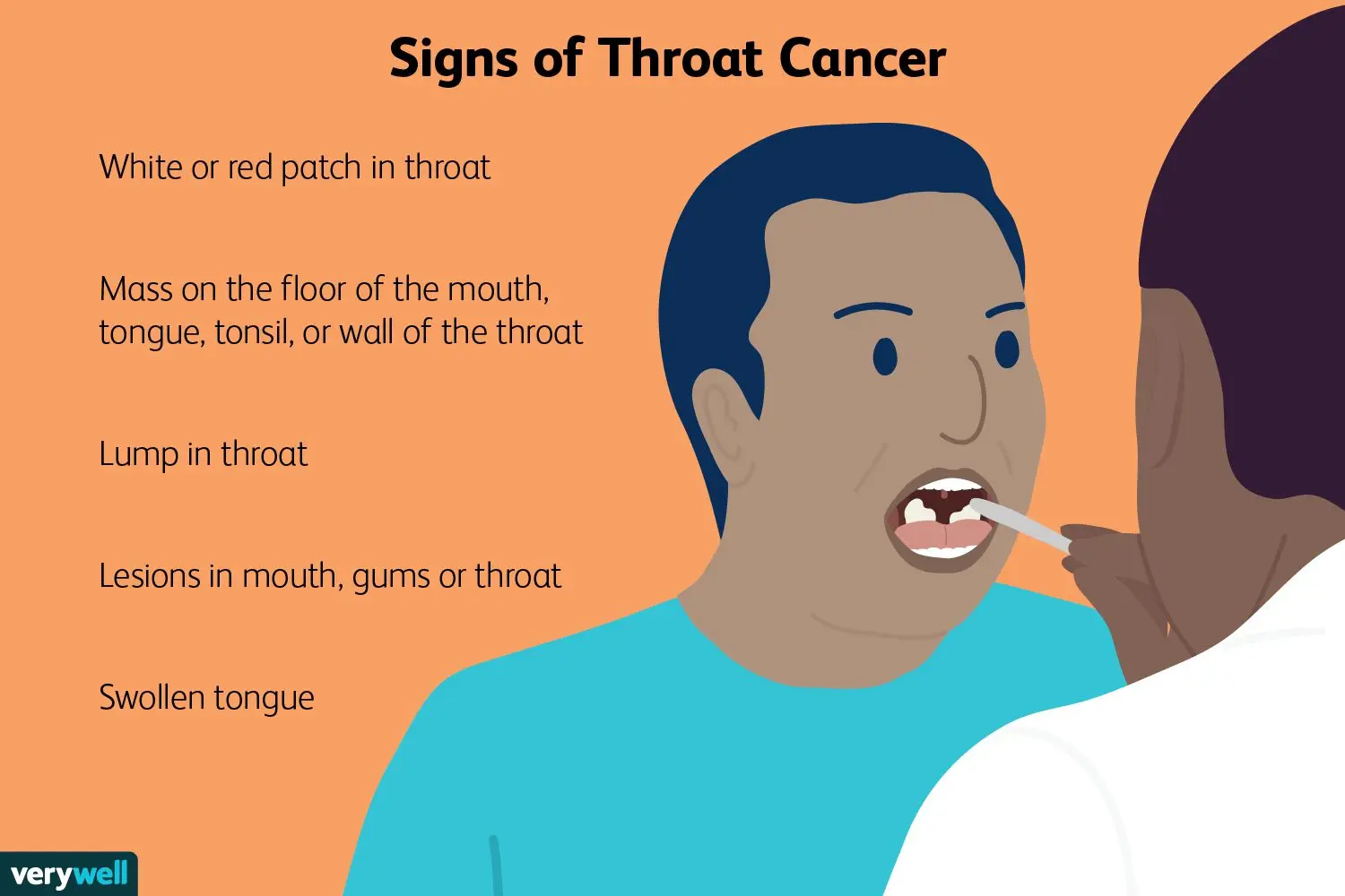 Benign Neoplasms of the Throat &#8211; Symptoms and Treatment