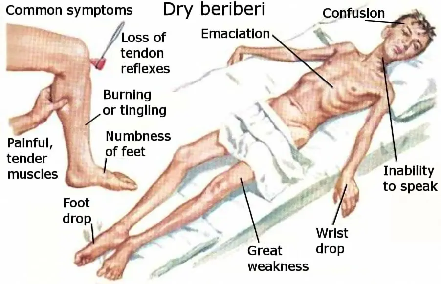 Beriberi &#8211; what is this disease? Symptoms, causes, treatment