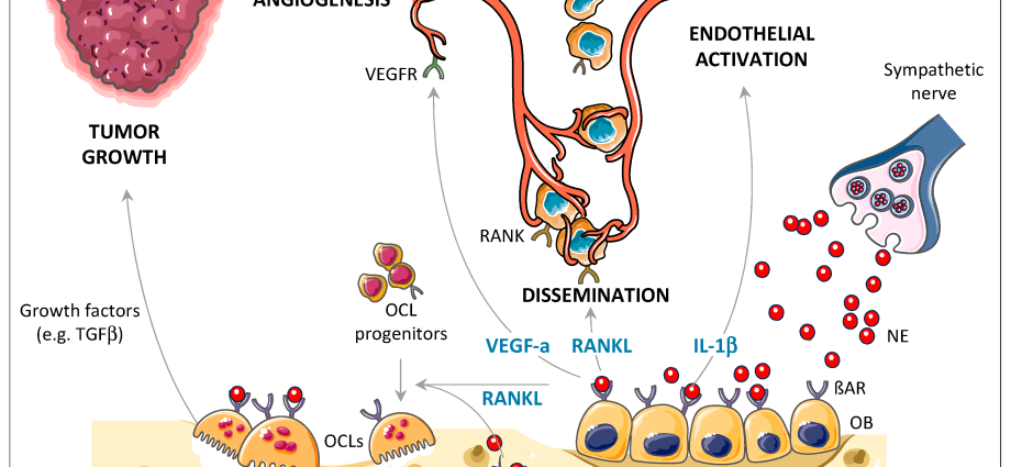 Beta-blockers can prevent breast cancer metastasis