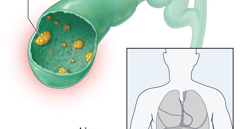 Biliary polyp &#8211; remove or observe?