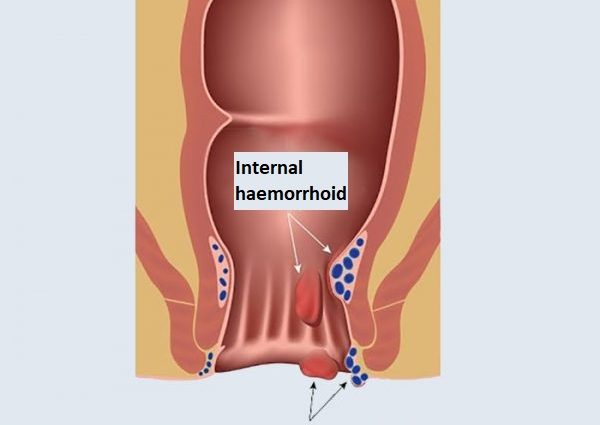 Biohemoril in the treatment of rectal haemorrhoids. Is it effective?