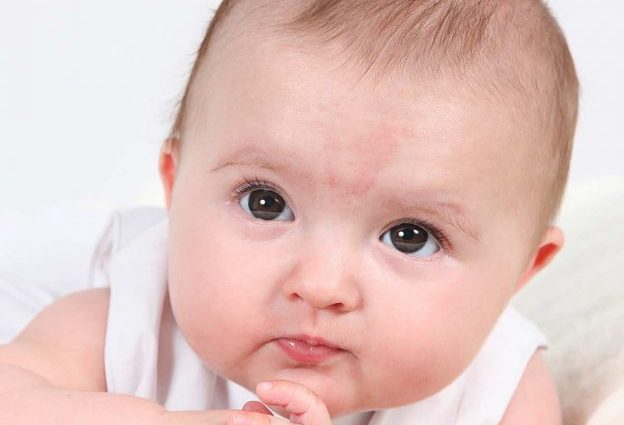 Birthmarks &#8211; causes, types, treatment, complications