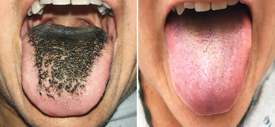 &#8220;Black hairy tongue&#8221; &#8211; a disease that can be caused by taking large amounts of antibiotics. What is it threatening to do?