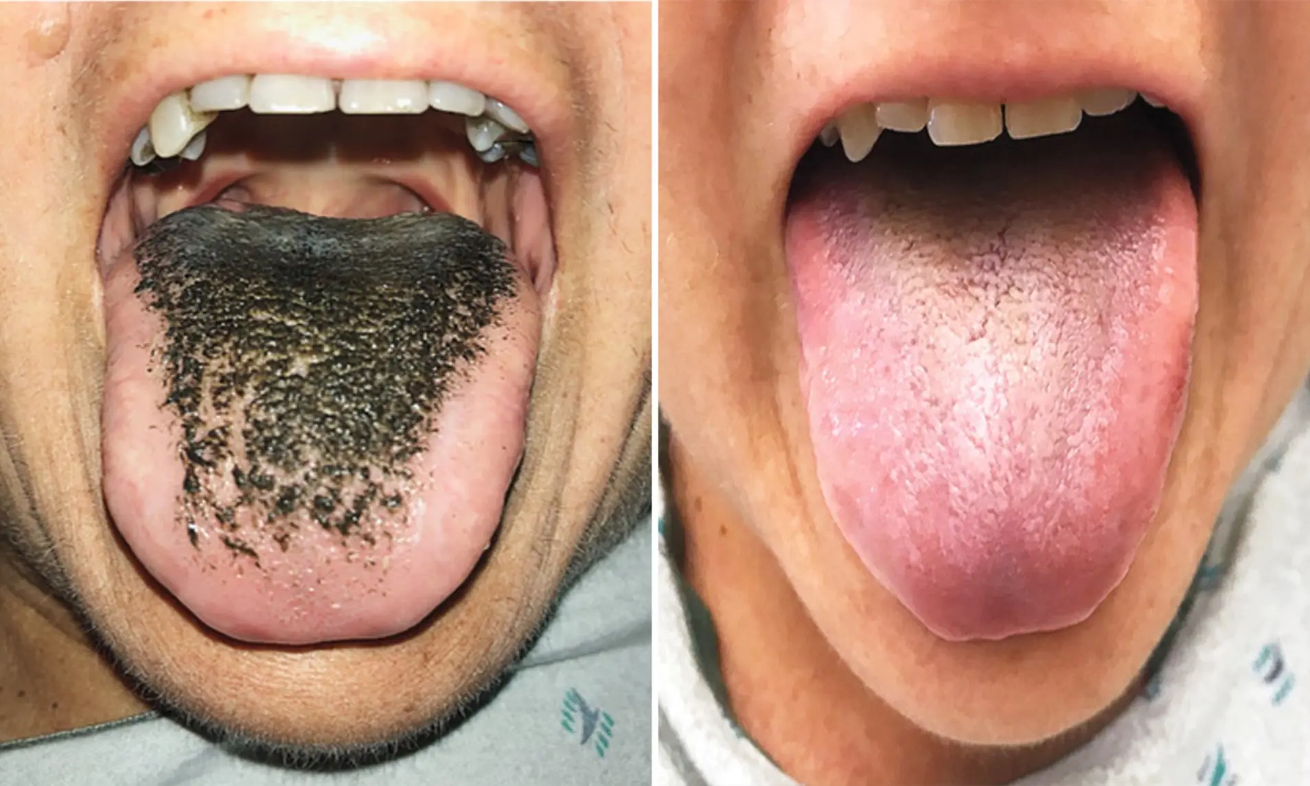 &#8220;Black hairy tongue&#8221; &#8211; a disease that can be caused by taking large amounts of antibiotics. What is it threatening to do?