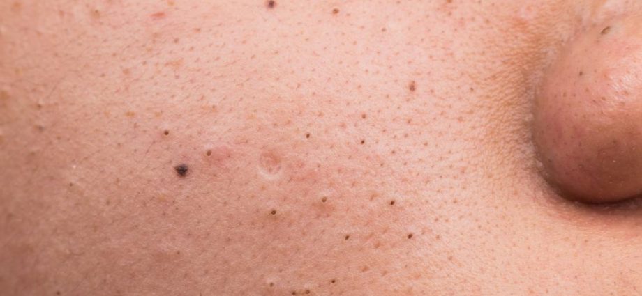 Blackhead acne &#8211; why does it appear? How to heal it?