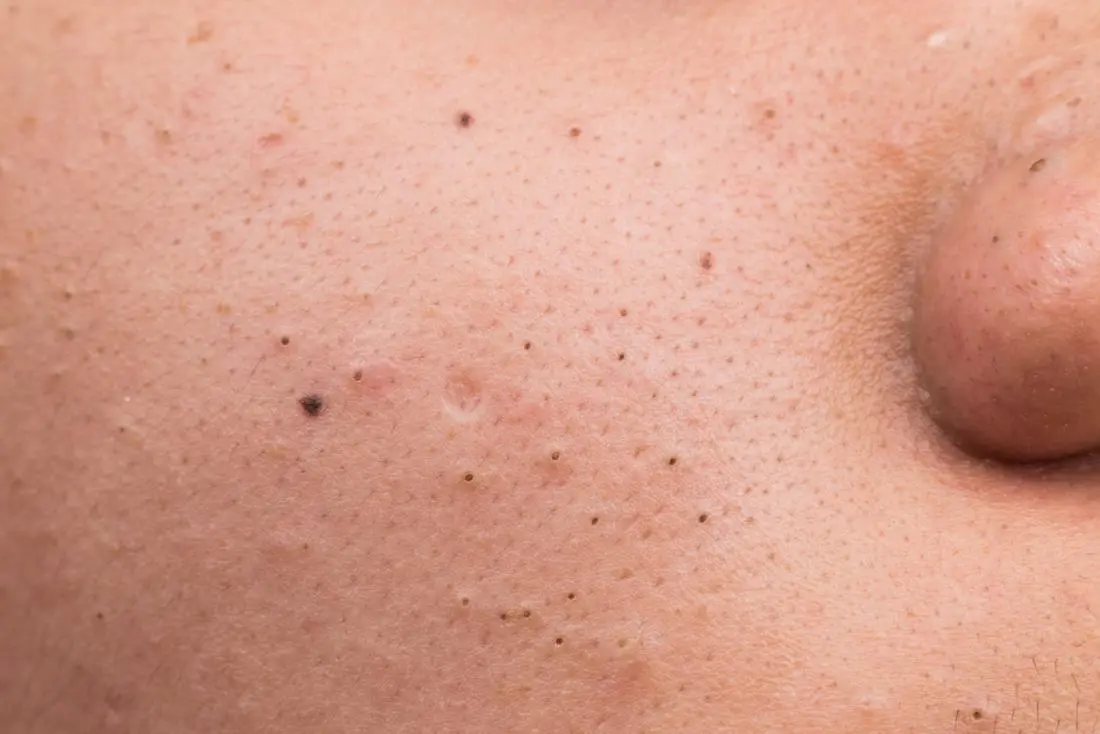 Blackhead acne &#8211; why does it appear? How to heal it?