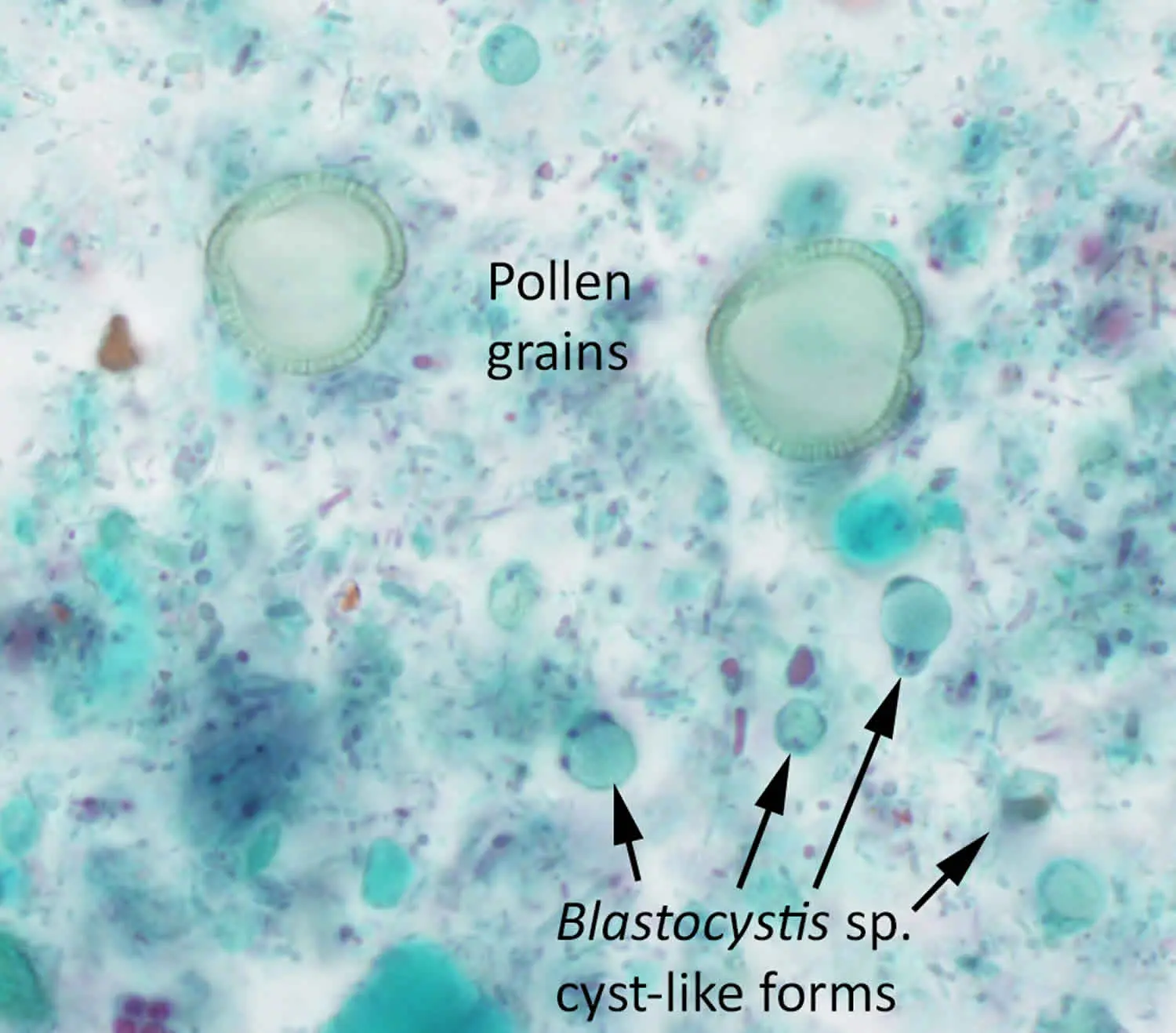 Blastocystosis &#8211; epidemiology, symptoms, diagnosis, treatment. How to prevent blastocystosis?