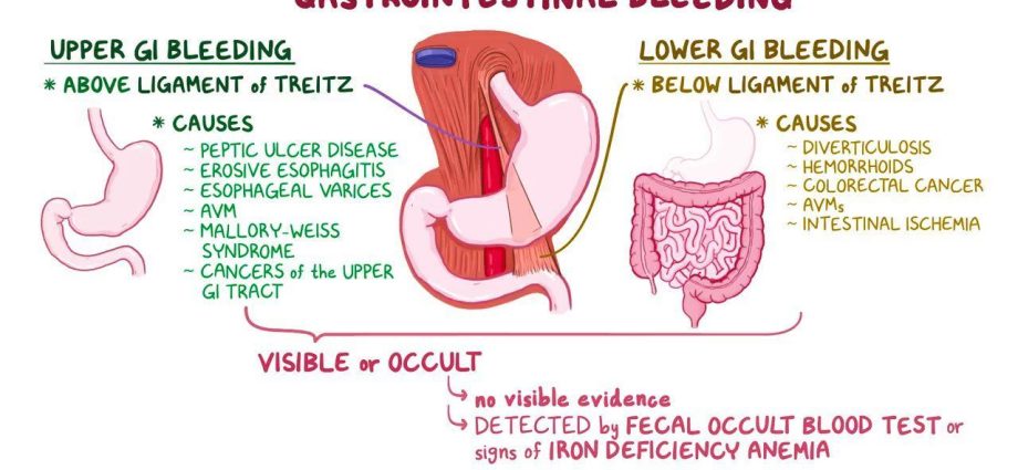 Bleeding from the upper gastrointestinal tract