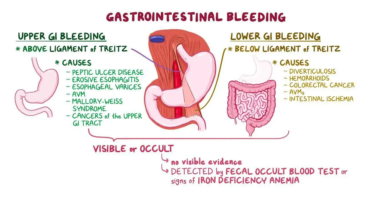 Bleeding from the upper gastrointestinal tract