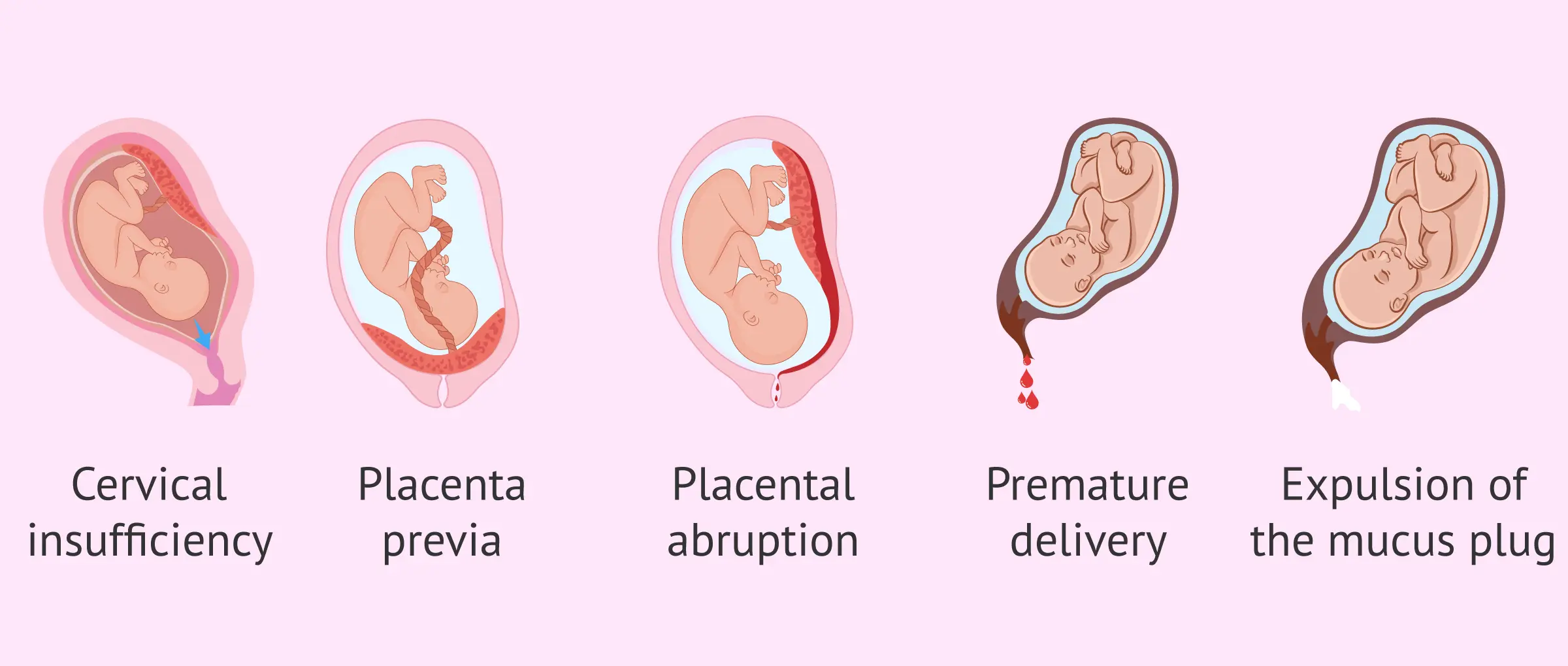 Bleeding in pregnancy &#8211; the main causes. Why should a doctor be consulted when bleeding during pregnancy?