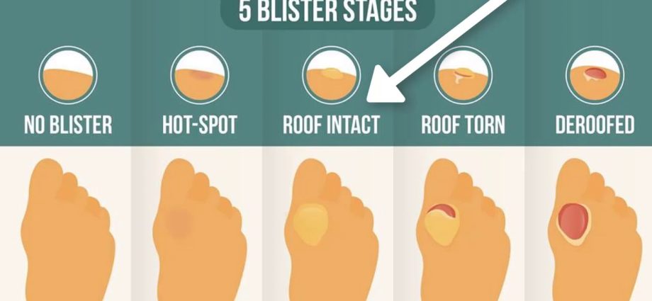 Blisters on the feet &#8211; how to deal with them so that they heal quickly?