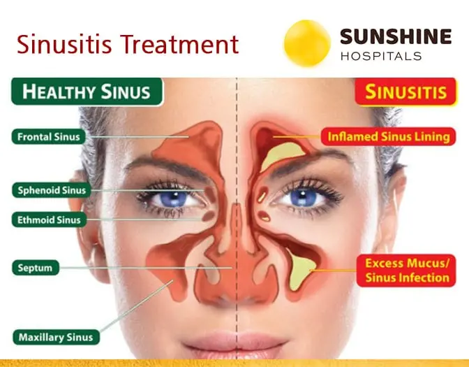 Blocked sinuses &#8211; treatment of sinusitis