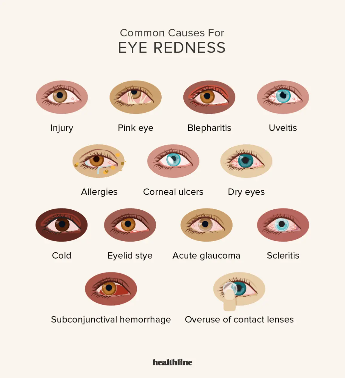 Bloodshot eyes &#8211; causes, treatment