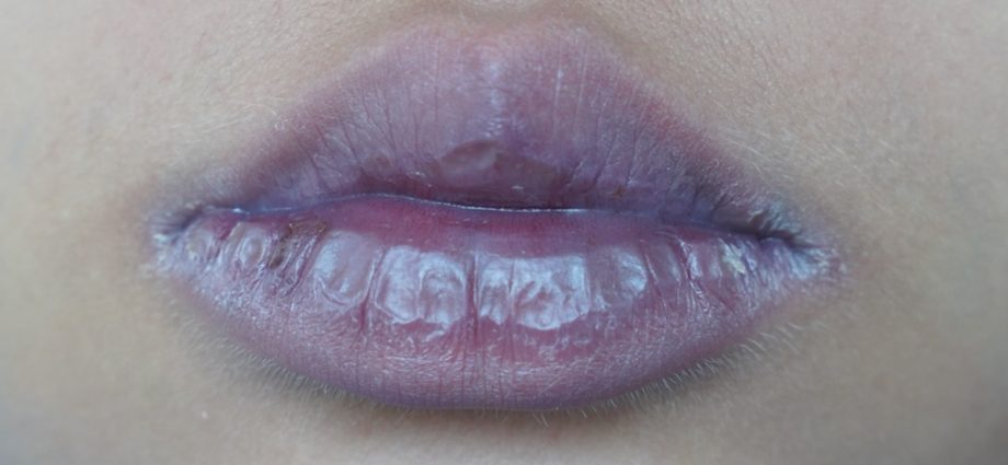 Bibir biru menandakan penyakit