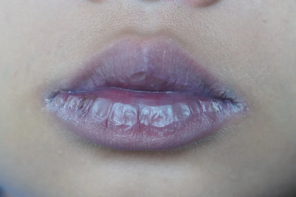 Blue lips signal illness