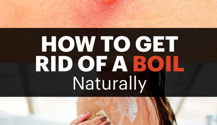 Boil &#8211; symptoms, treatment. How to avoid a boil?