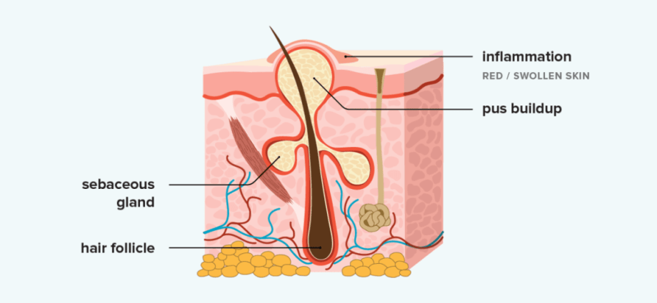 Boils &#8211; how to heal when they recur?