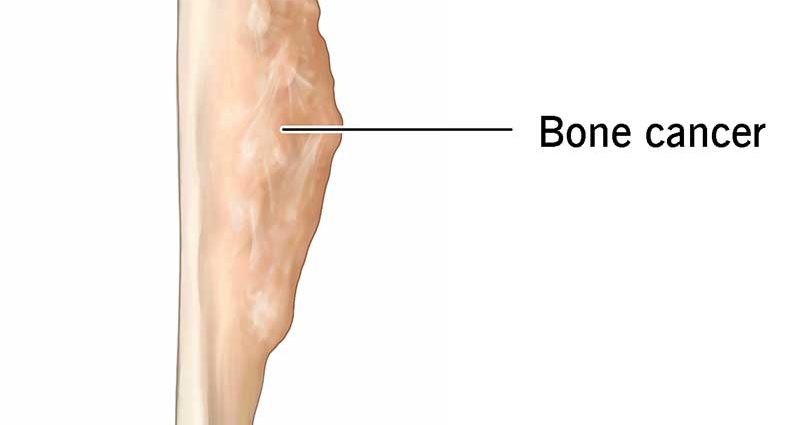 Bone cancer (bone cancer)