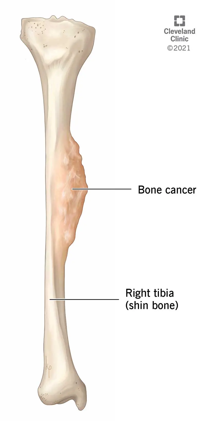 Bone cancer (bone cancer)