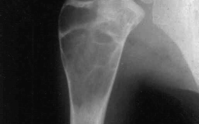 Bone cysts