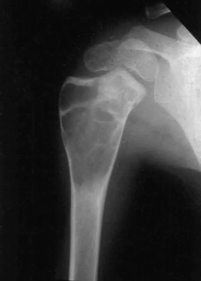 Bone cysts