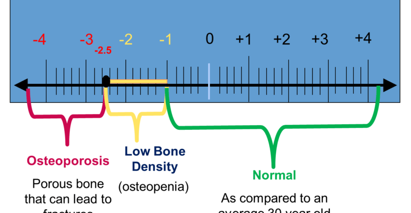 Bone density measurement &#8211; densitometry, measurement process, results