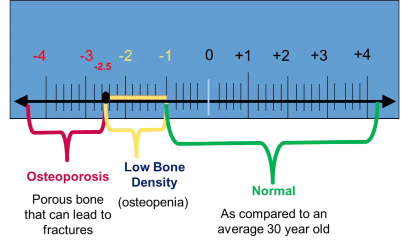 Bone density measurement &#8211; densitometry, measurement process, results