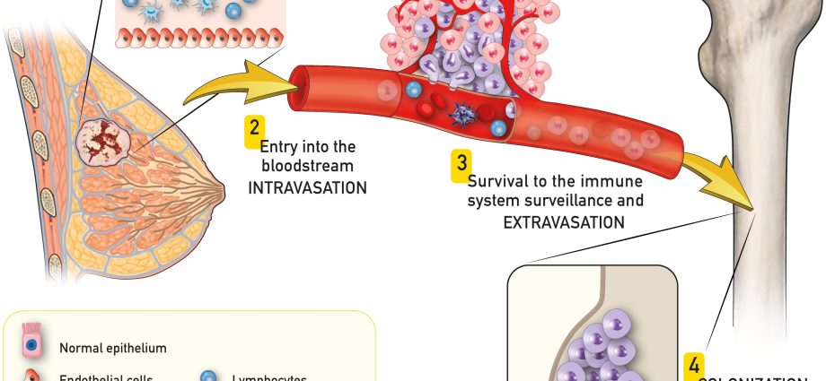 Bone metastases can be treated effectively