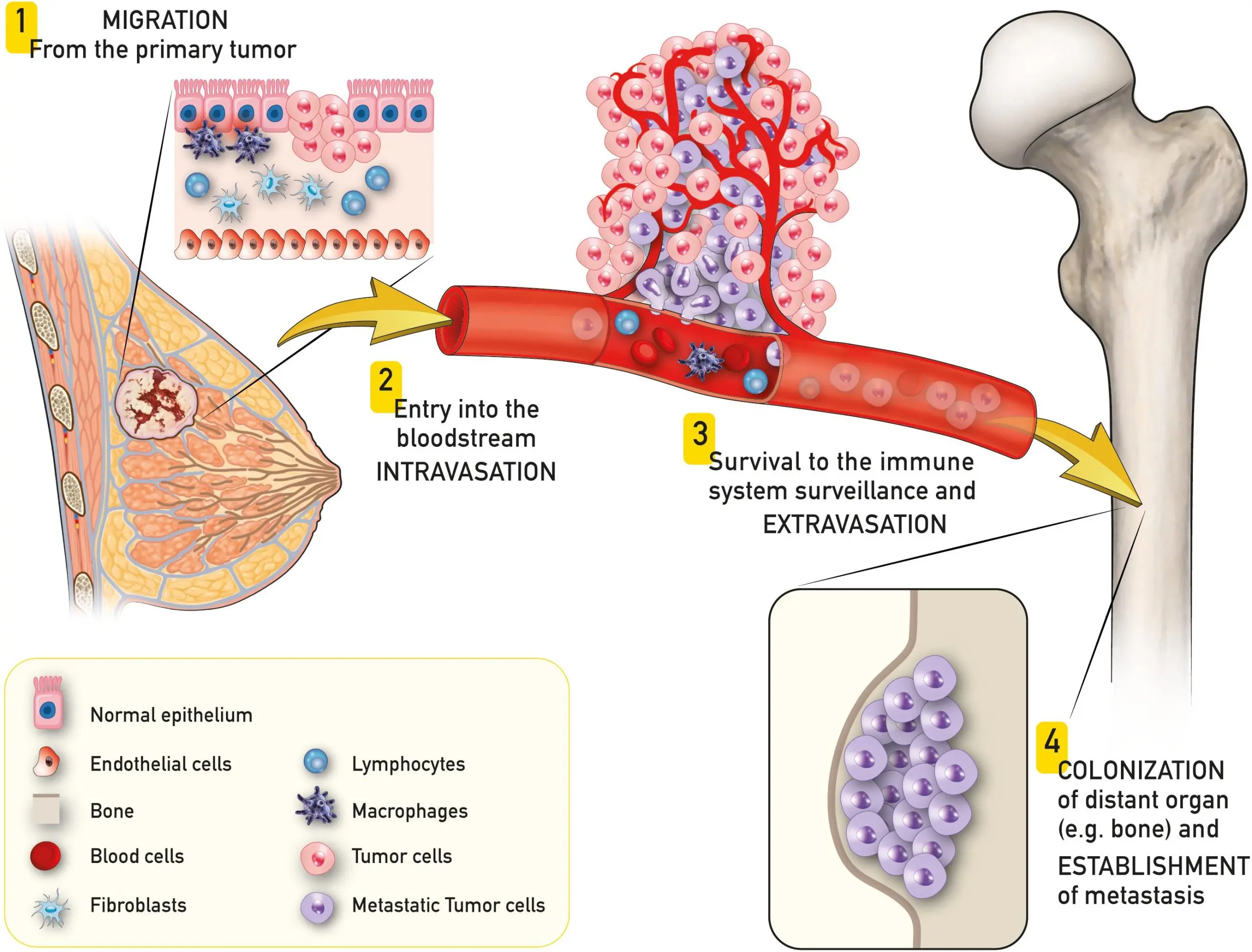 Bone metastases can be treated effectively