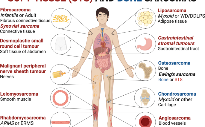 Bone sarcomas can be cured