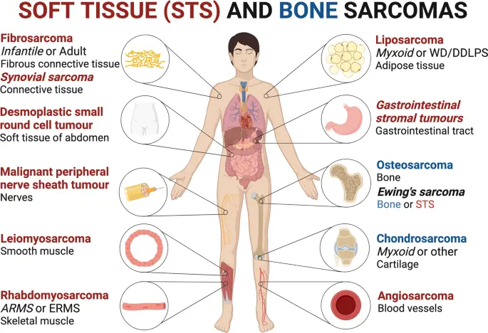 Bone sarcomas can be cured