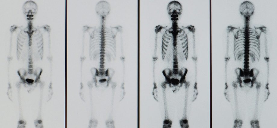 Bone scintigraphy &#8211; how to prepare for the examination? Scintigraphy results