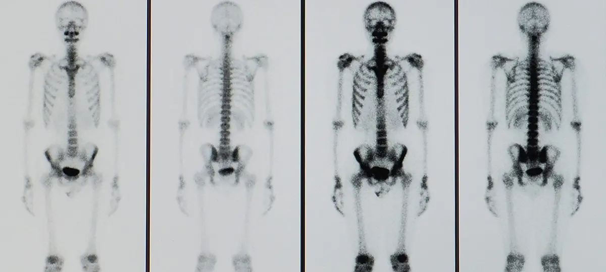 Bone scintigraphy &#8211; how to prepare for the examination? Scintigraphy results